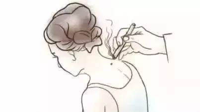 南陽(yáng)艾條分享  中醫艾灸緩解胃痛